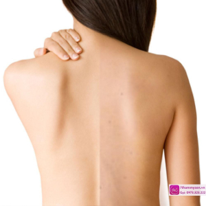 Triệt L&ocirc;ng V&ugrave;ng Lưng 