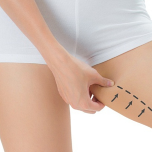 Đ&agrave;o Thải Mỡ V&ugrave;ng Đ&ugrave;i