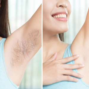 Triệt L&ocirc;ng V&ugrave;ng N&aacute;ch