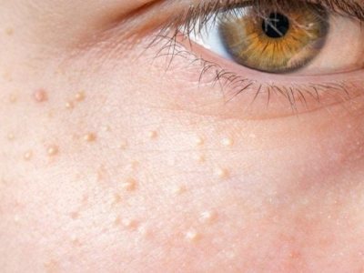 Bật m&iacute; c&aacute;ch trị mụn thịt đơn giản tại nh&agrave; hiệu quả được chuy&ecirc;n gia thẩm mỹ khuy&ecirc;n d&ugrave;ng