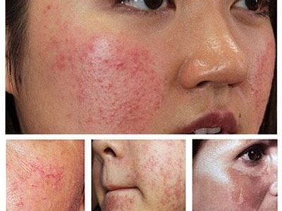 B&iacute; Quyết Phục Hồi Da Nhiễm Corticoid Nhẹ: H&agrave;nh Tr&igrave;nh Trở Lại L&agrave;n Da Khỏe Đẹp