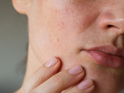 Da mặt bị thiếu độ ẩm phải l&agrave;m sao? Thực hiện trẻ ho&aacute; da PRP ngay