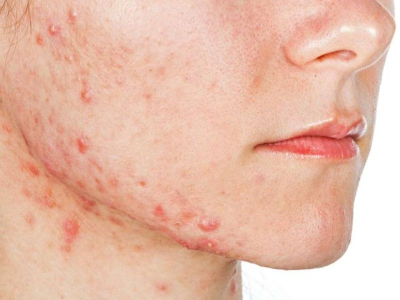 Đ&agrave;o tạo nghề spa c&aacute;ch chăm s&oacute;c da dầu nhờn hiệu quả hết mụn ngay