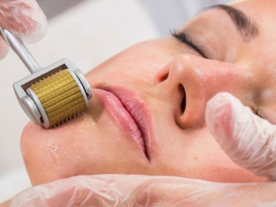 Lăn kim trẻ h&oacute;a da mặt