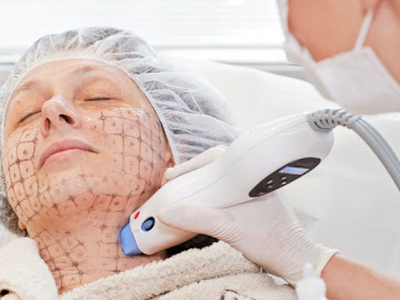 Trẻ h&oacute;a da với c&ocirc;ng nghệ Thermage