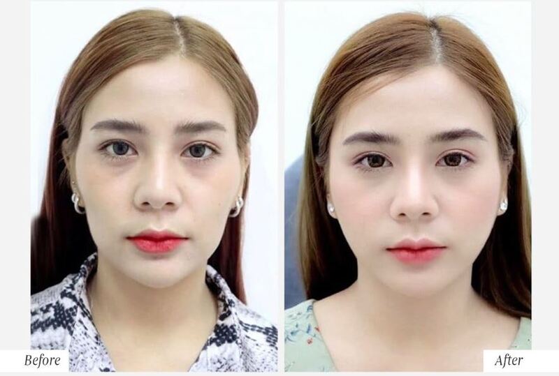 Kỹ thuật trẻ hóa da đa tầng- cứu cánh của ngàn phái đẹp 