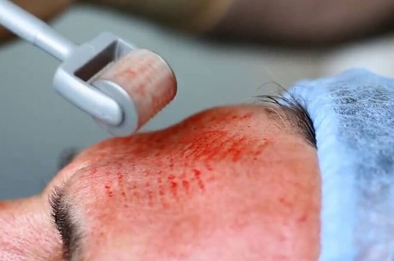 Phương pháp trẻ hoá da sử dụng máu tự thân