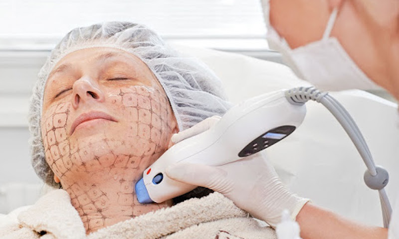 Trẻ hóa da với công nghệ Thermage