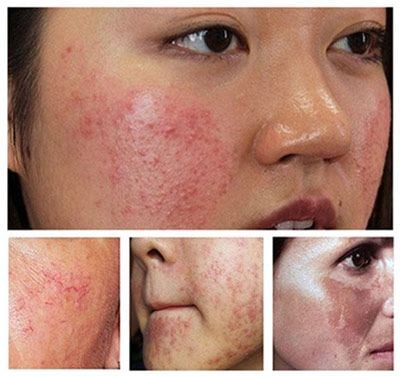 B&iacute; Quyết Phục Hồi Da Nhiễm Corticoid Nhẹ: H&agrave;nh Tr&igrave;nh Trở Lại L&agrave;n Da Khỏe Đẹp