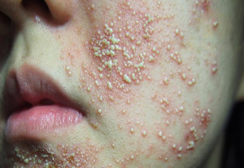 Nhận Biết Da Bị Nhiễm Corticoid: Dấu Hiệu Nguy Hiểm V&agrave; C&aacute;ch Khắc Phục An To&agrave;n